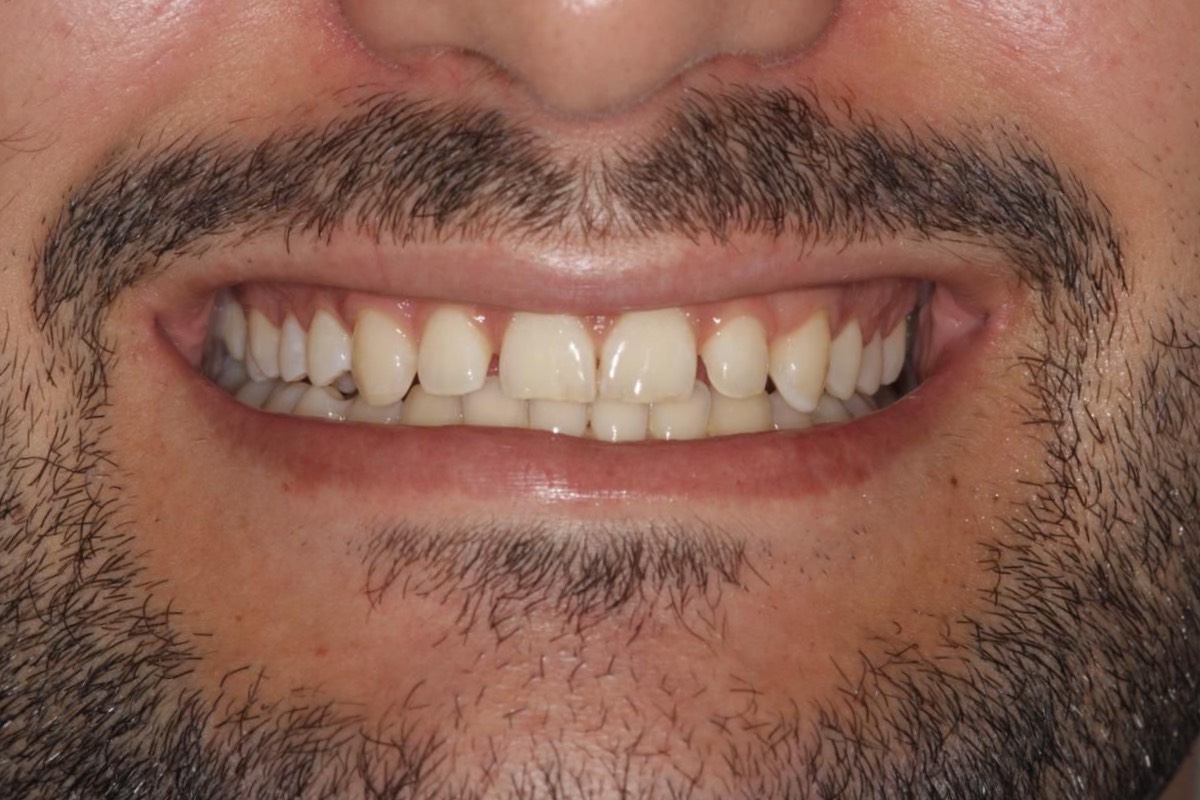 antes